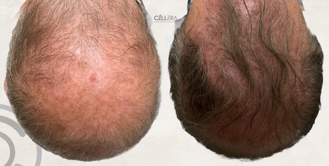 Hairbooster